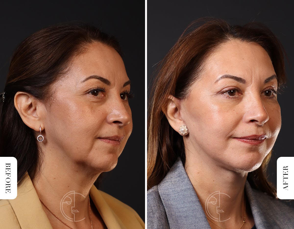 Miami Facelift/Neck Lift Before & After Gallery - Patient 176378 - Image 1 - The Chopra Plastic Surgery Center