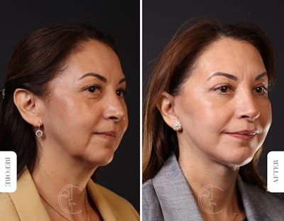 Miami Facelift Before & After Gallery - Patient 176378 - Image 1 - The Chopra Plastic Surgery Center