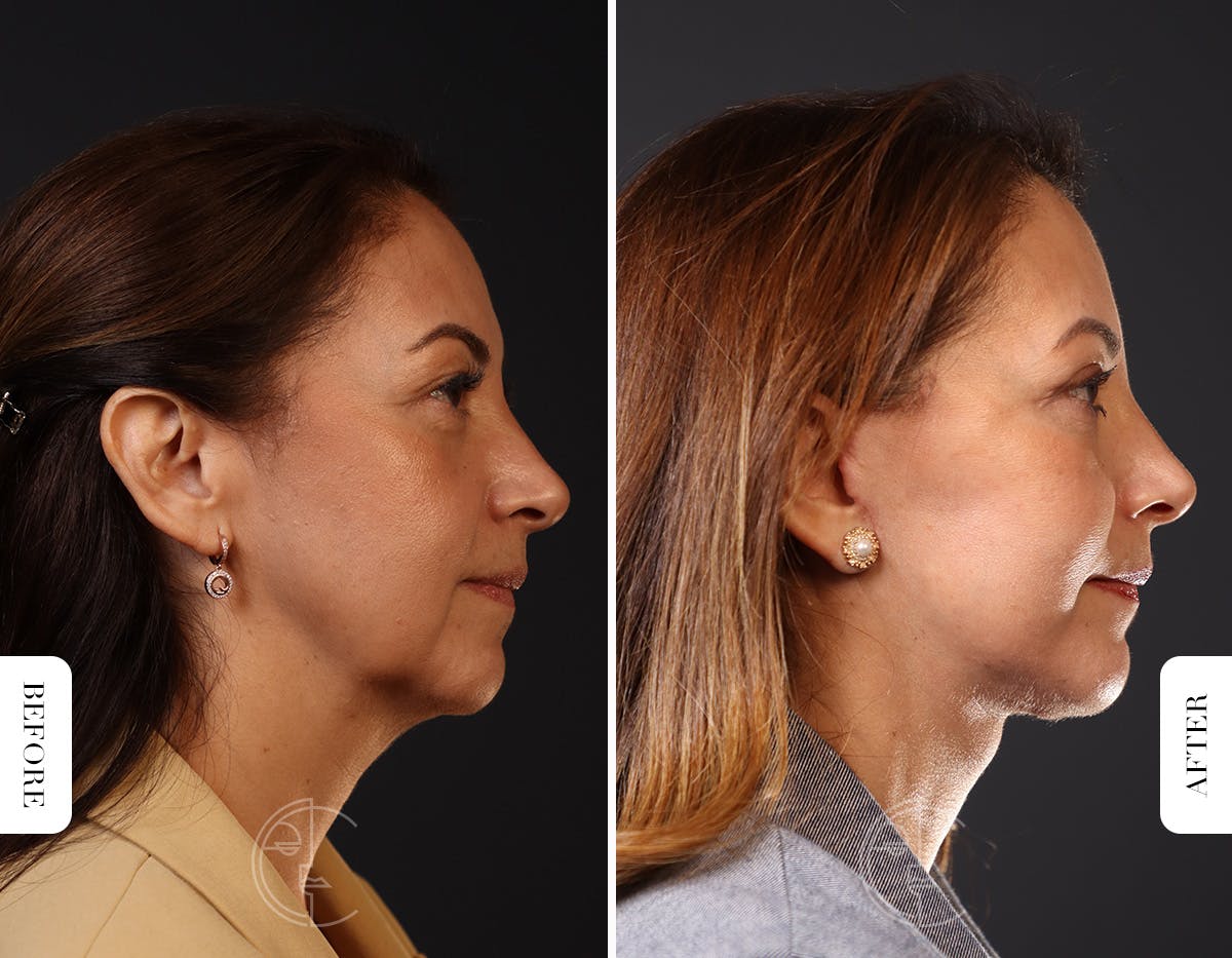 Miami Facelift/Neck Lift Before & After Gallery - Patient 176378 - Image 2 - The Chopra Plastic Surgery Center