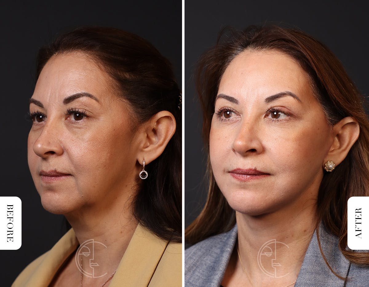 Miami Facelift/Neck Lift Before & After Gallery - Patient 176378 - Image 4 - The Chopra Plastic Surgery Center