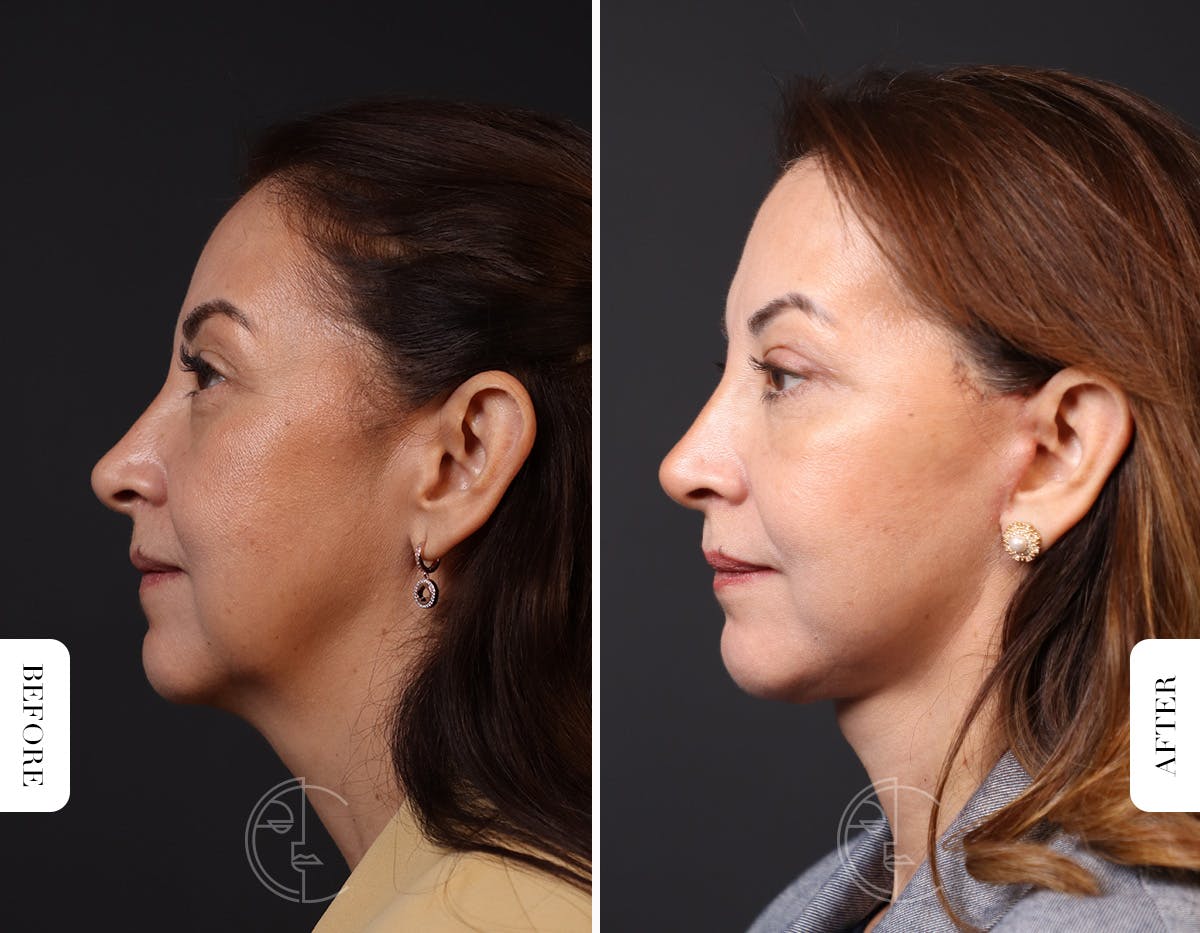 Miami Facelift/Neck Lift Before & After Gallery - Patient 176378 - Image 5 - The Chopra Plastic Surgery Center