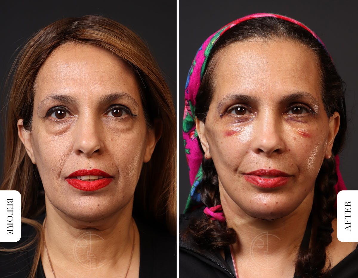 Miami Neck Lift Before & After Gallery - Patient 326585 - Image 2 - The Chopra Plastic Surgery Center