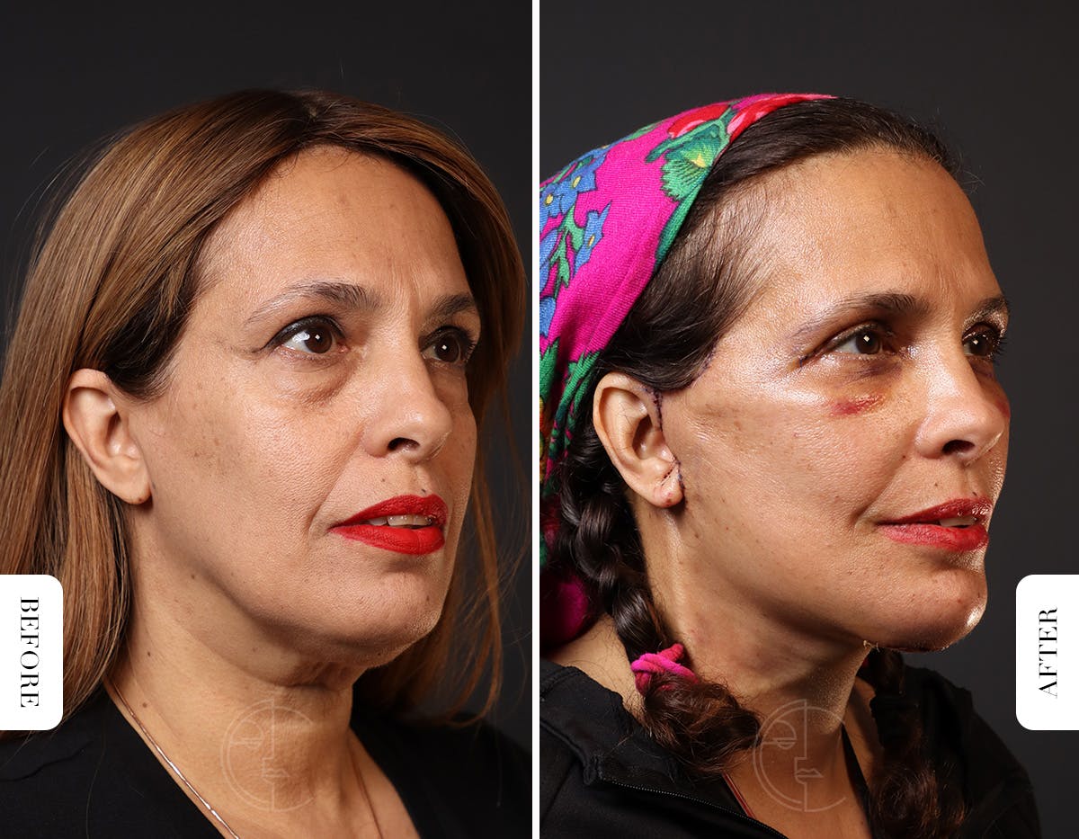 Miami Neck Lift Before & After Gallery - Patient 326585 - Image 1 - The Chopra Plastic Surgery Center