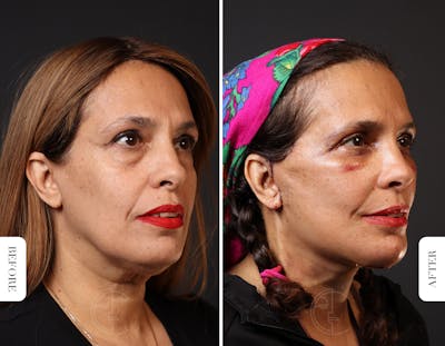 Miami Facelift Before & After Gallery - Patient 327050 - Image 1 - The Chopra Plastic Surgery Center