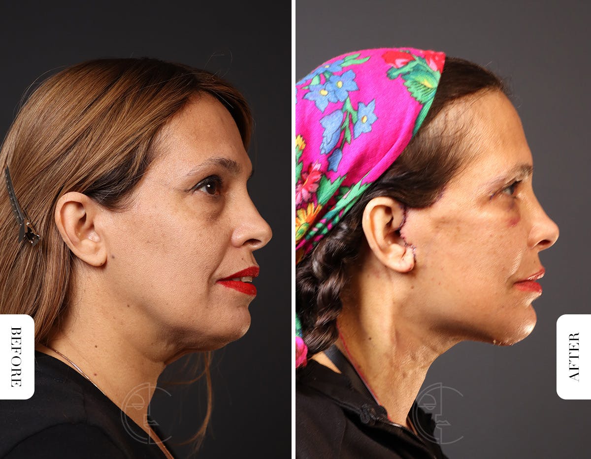 Miami Neck Lift Before & After Gallery - Patient 326585 - Image 3 - The Chopra Plastic Surgery Center