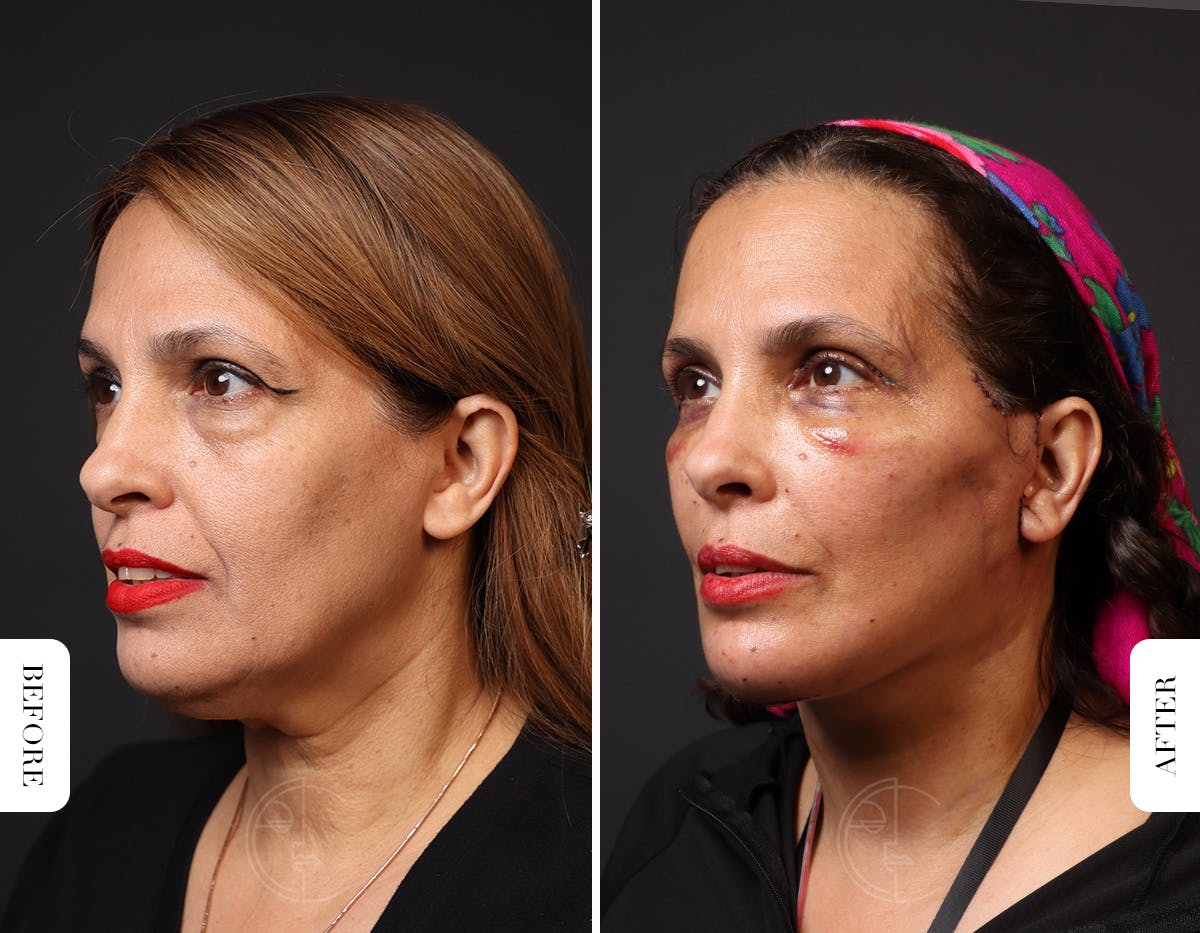 Miami Neck Lift Before & After Gallery - Patient 326585 - Image 4 - The Chopra Plastic Surgery Center