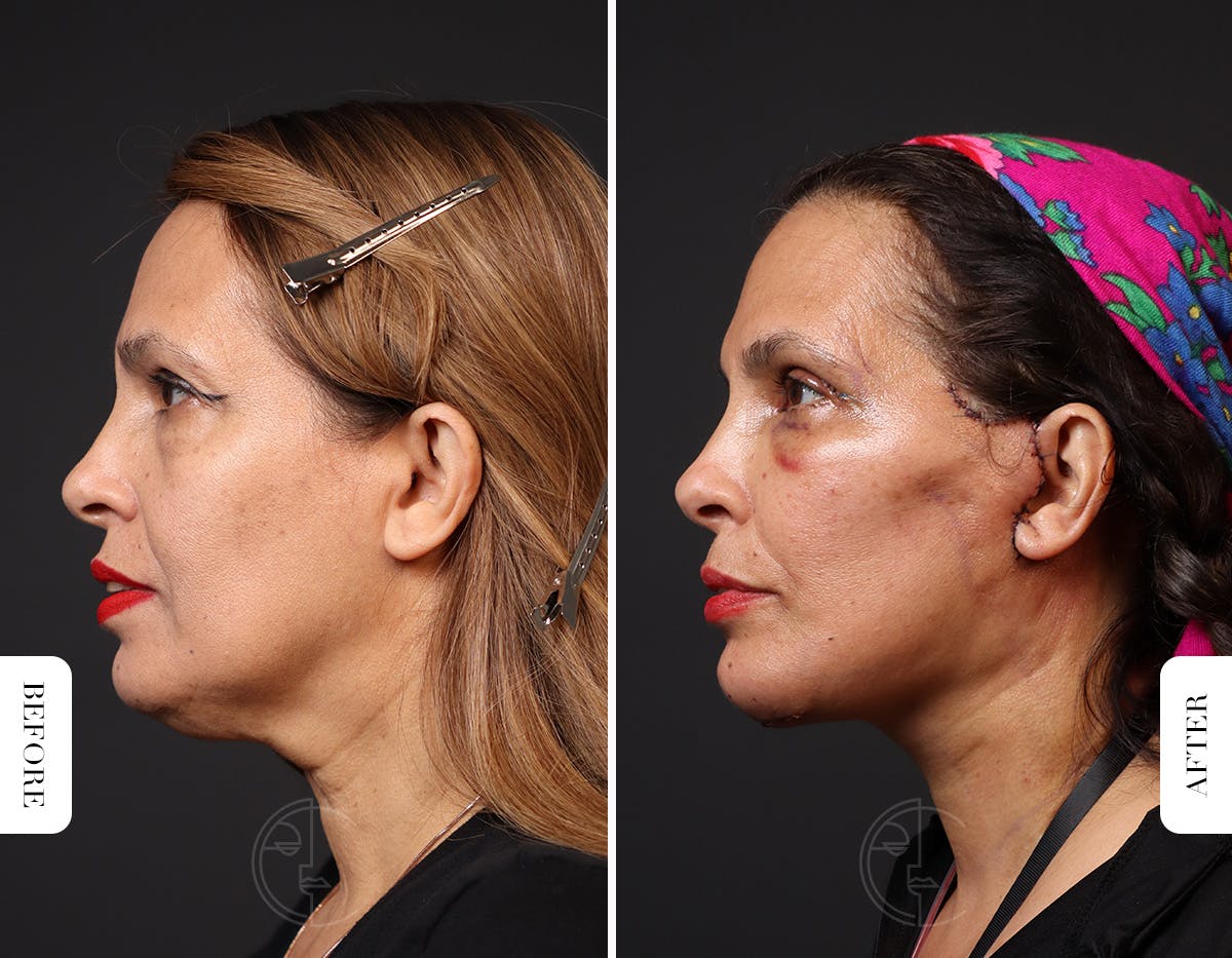 Miami Neck Lift Before & After Gallery - Patient 326585 - Image 5 - The Chopra Plastic Surgery Center
