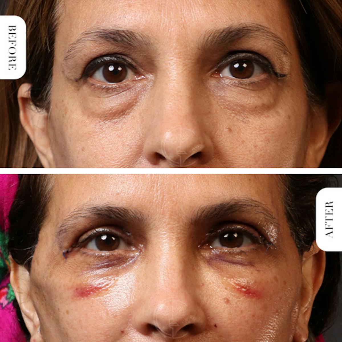 Miami Upper Eyelid Lift Before & After Gallery - Patient 102879 - Image 1 - The Chopra Plastic Surgery Center