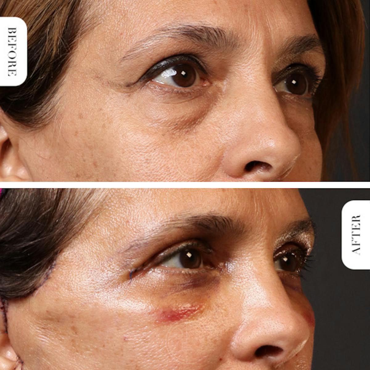 Miami Upper Eyelid Lift Before & After Gallery - Patient 102879 - Image 2 - The Chopra Plastic Surgery Center