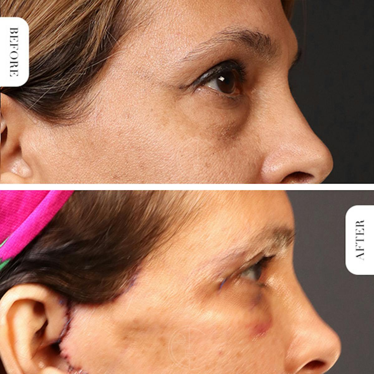 Miami Upper Eyelid Lift Before & After Gallery - Patient 102879 - Image 3 - The Chopra Plastic Surgery Center