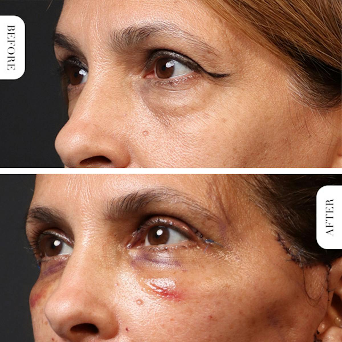 Miami Upper Eyelid Lift Before & After Gallery - Patient 102879 - Image 4 - The Chopra Plastic Surgery Center