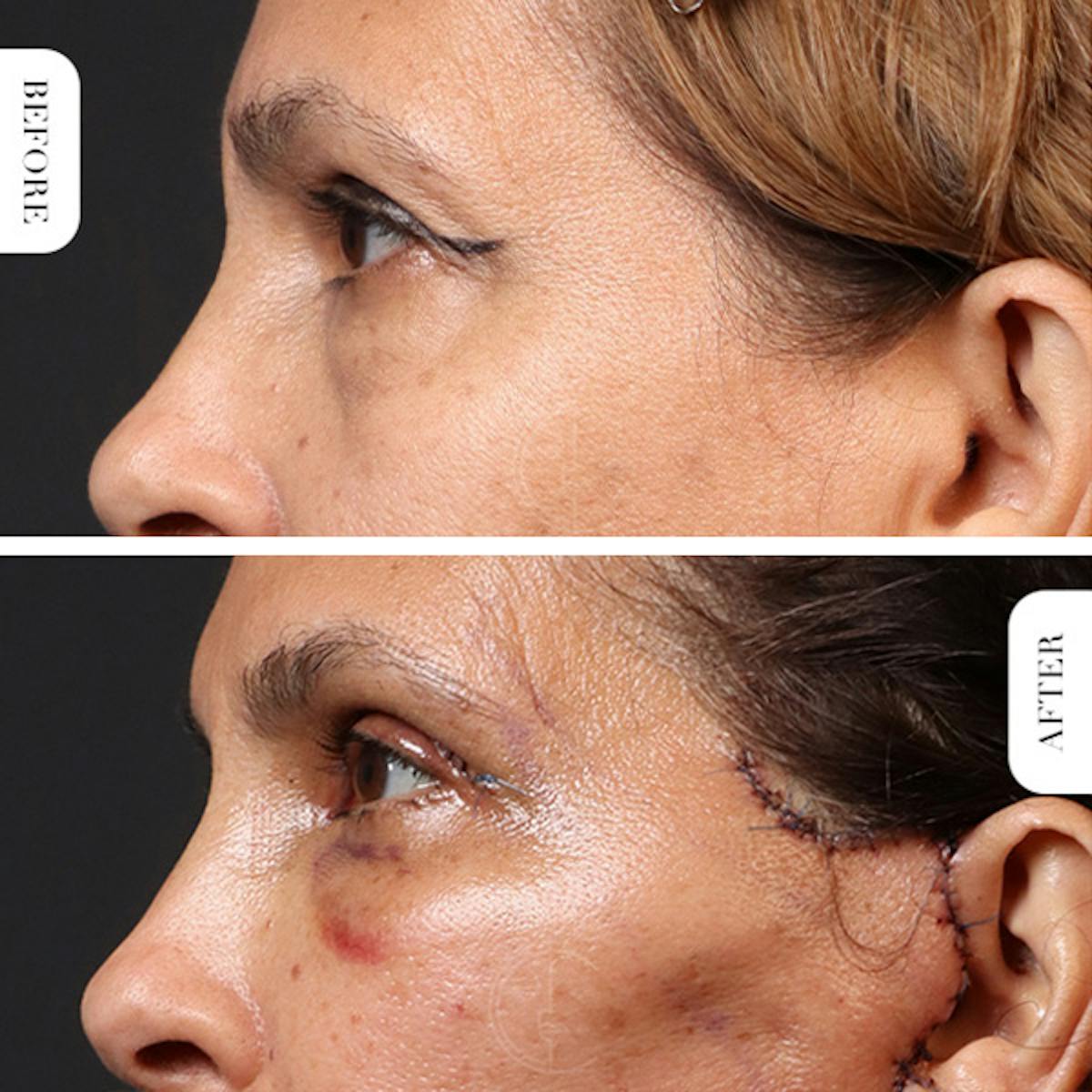 Miami Upper Eyelid Lift Before & After Gallery - Patient 102879 - Image 5 - The Chopra Plastic Surgery Center