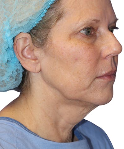 Facelift Before & After Gallery - Patient 177919 - Image 1