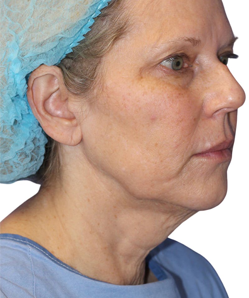 Facelift Before & After Gallery - Patient 177919 - Image 1