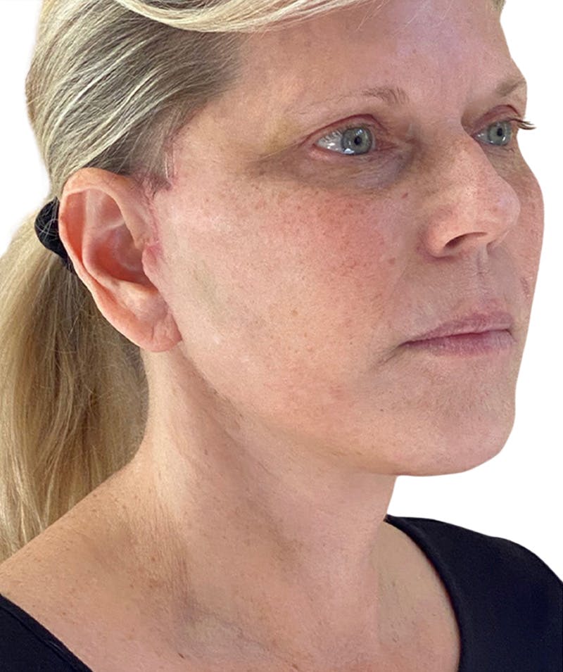 Facelift Before & After Gallery - Patient 177919 - Image 2