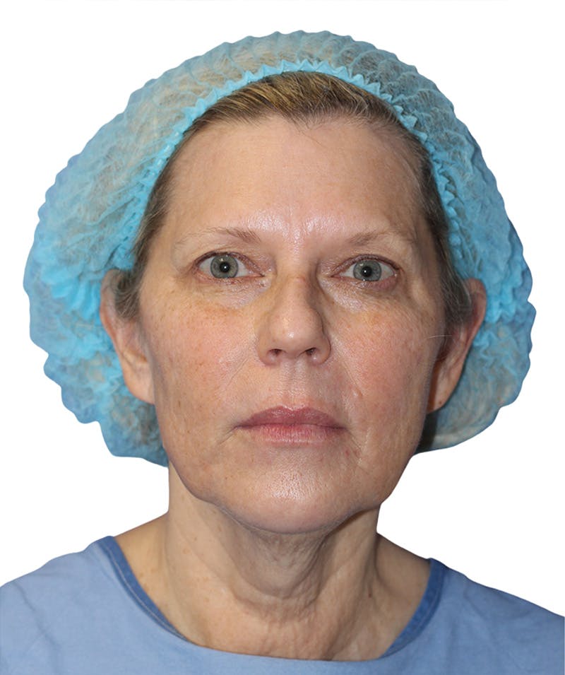 Facelift Before & After Gallery - Patient 177919 - Image 3