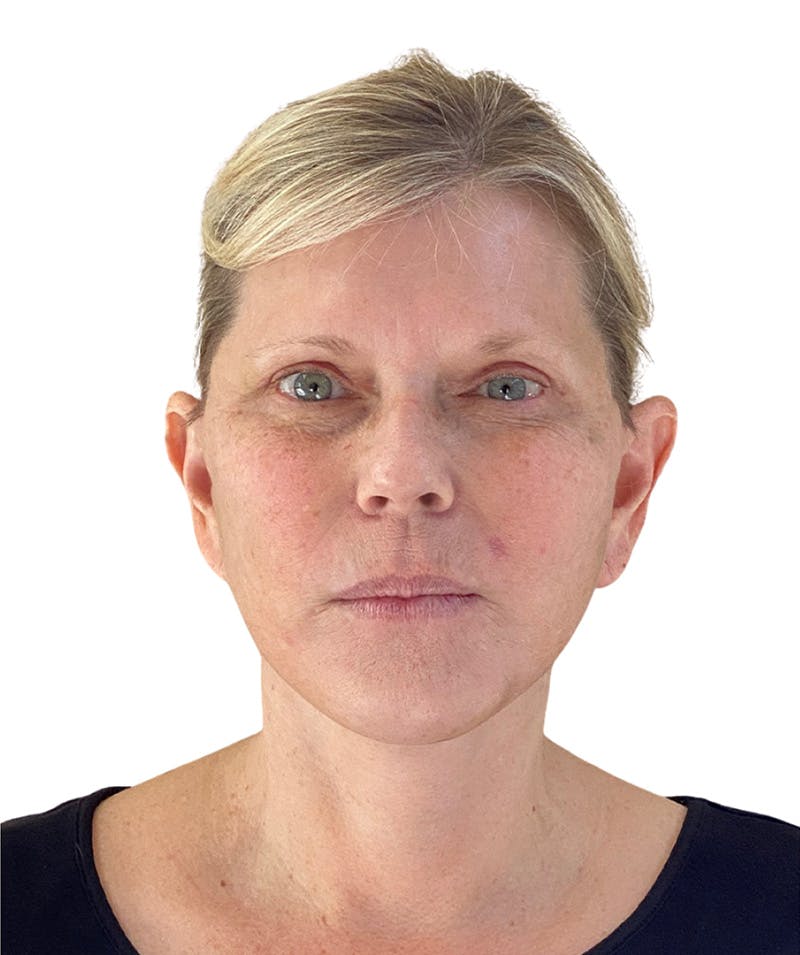 Facelift Before & After Gallery - Patient 177919 - Image 4