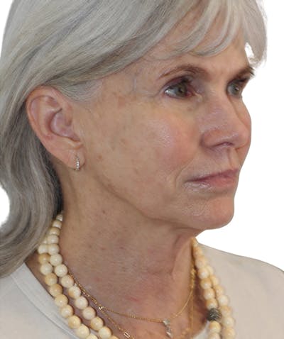 Facelift Before & After Gallery - Patient 130030 - Image 1