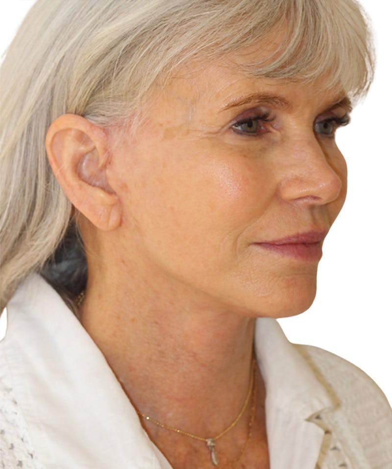 Facelift Before & After Gallery - Patient 130030 - Image 2