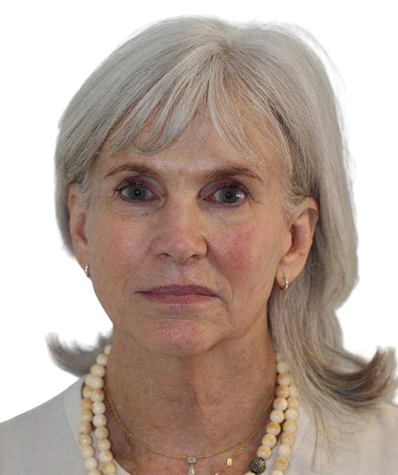 Facelift Before & After Gallery - Patient 130030 - Image 3