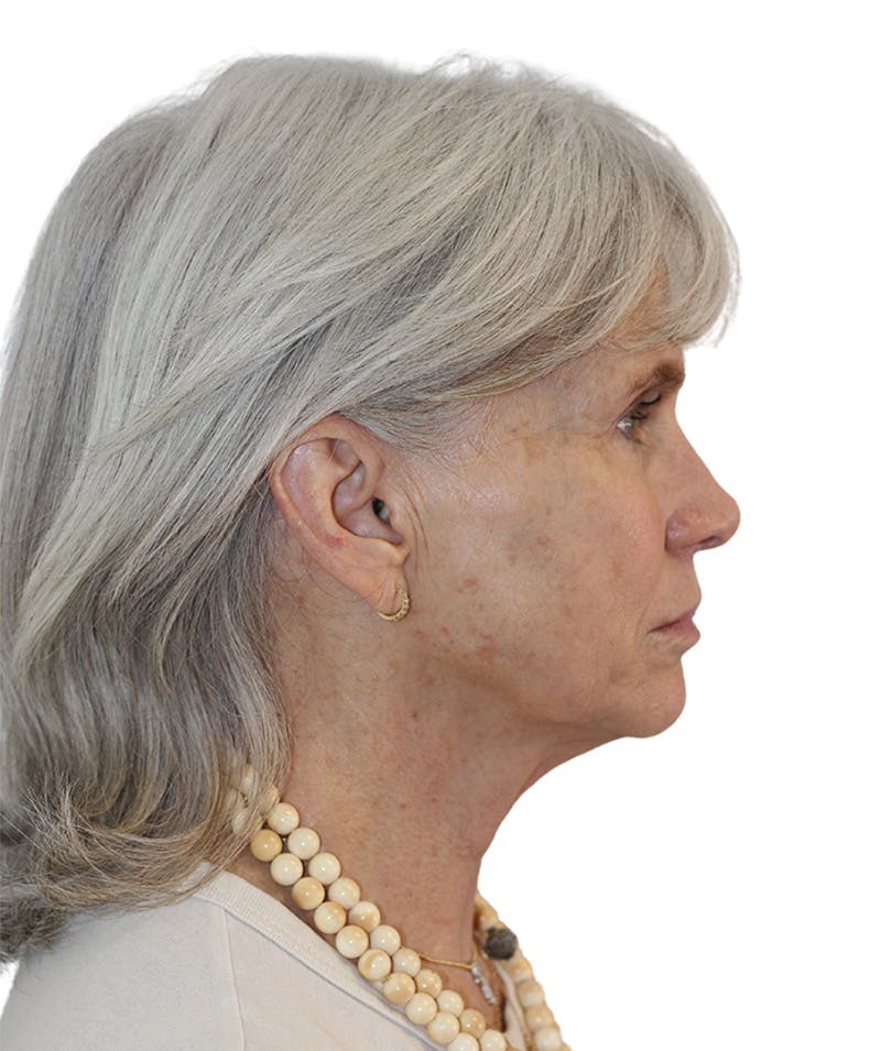 Facelift Before & After Gallery - Patient 130030 - Image 5