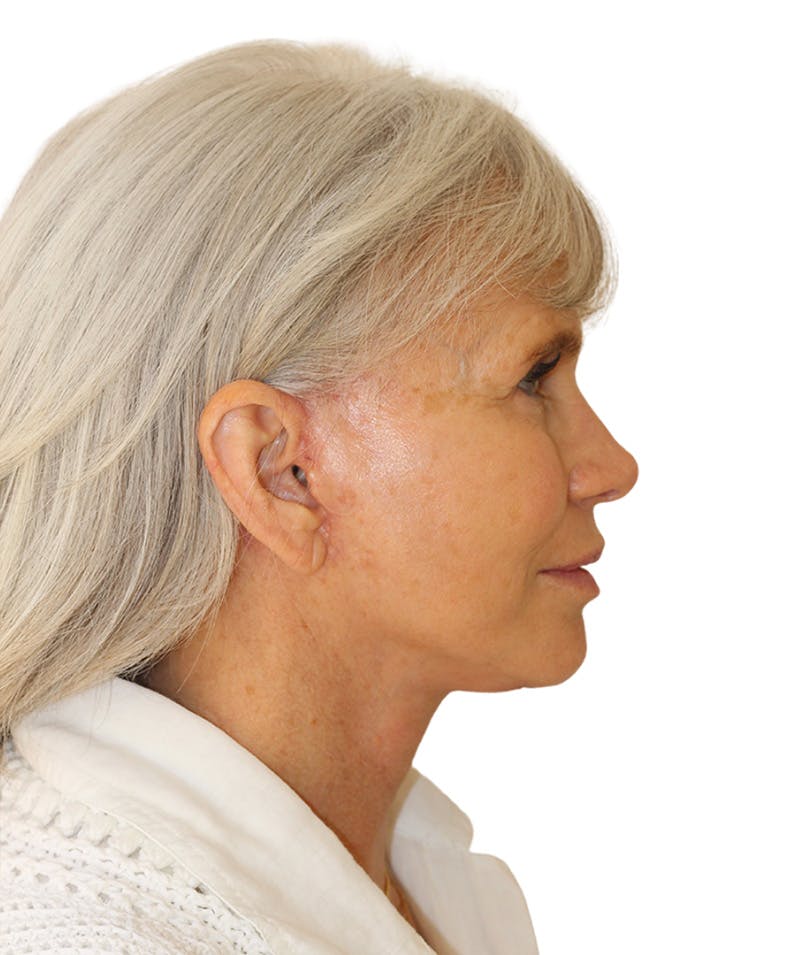 Facelift Before & After Gallery - Patient 130030 - Image 6