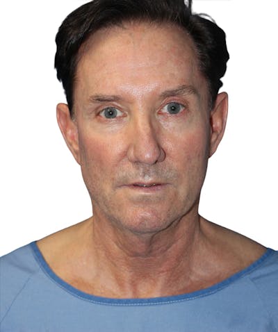 Facelift Before & After Gallery - Patient 454273 - Image 1