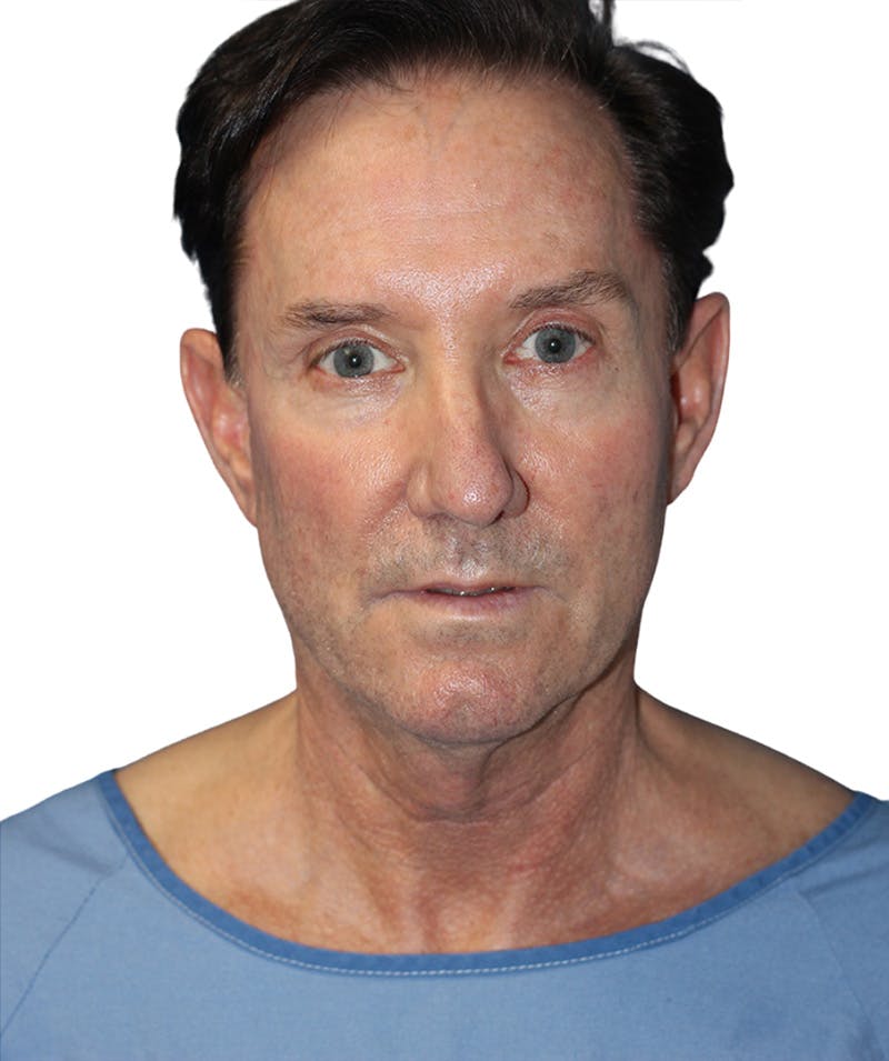 Facelift Before & After Gallery - Patient 454273 - Image 1