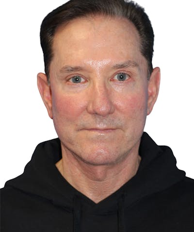 Facelift Before & After Gallery - Patient 454273 - Image 2