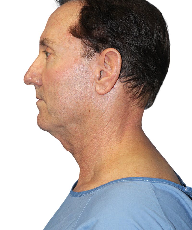 Facelift Before & After Gallery - Patient 454273 - Image 3