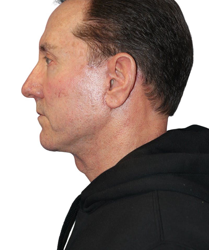 Facelift Before & After Gallery - Patient 454273 - Image 4