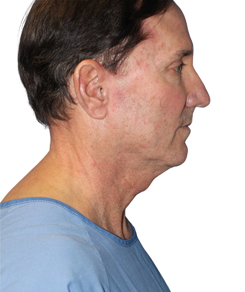 Facelift Before & After Gallery - Patient 454273 - Image 5
