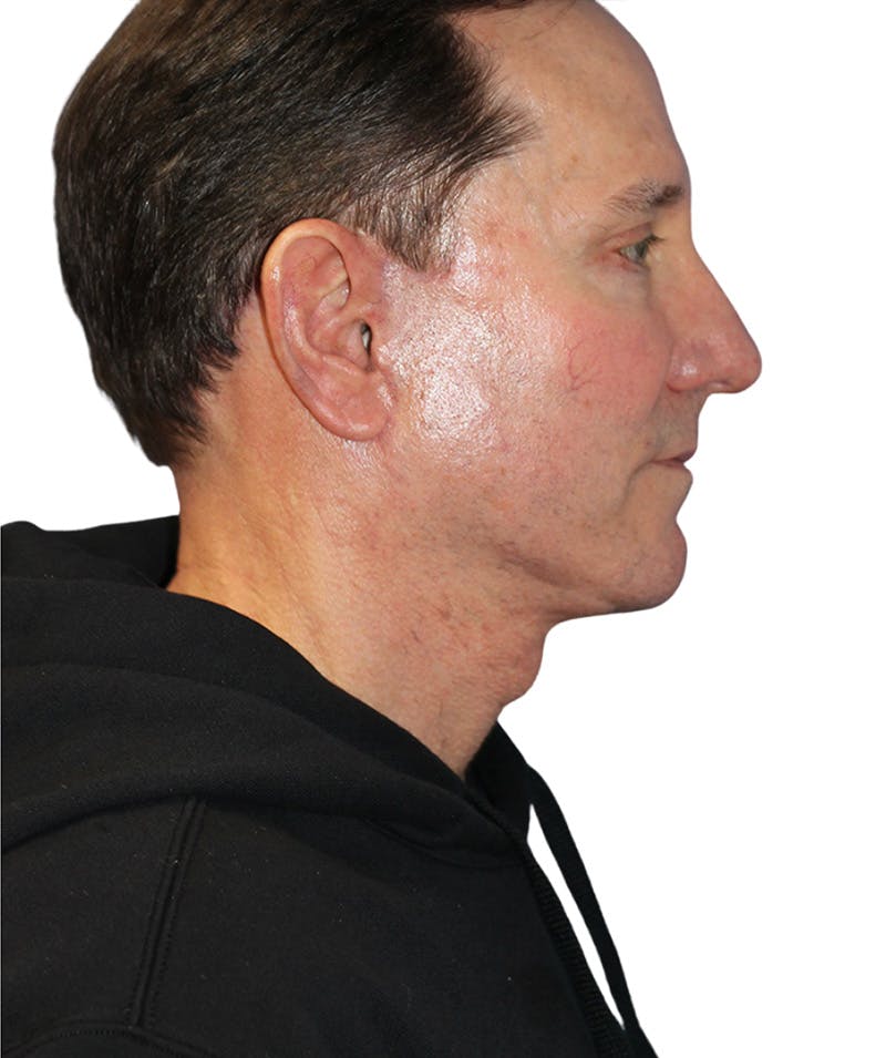 Facelift Before & After Gallery - Patient 454273 - Image 6