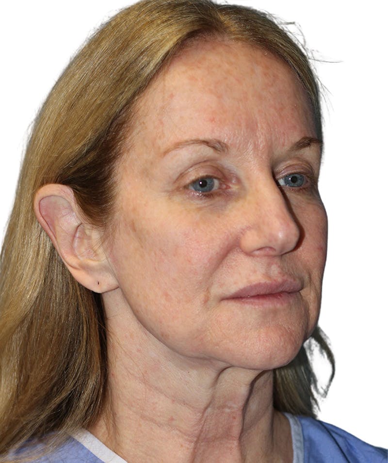 Facelift Before & After Gallery - Patient 399811 - Image 1