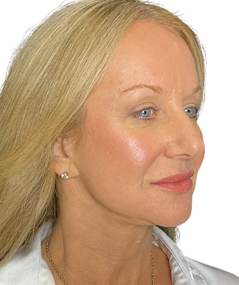 Facelift Before & After Gallery - Patient 399811 - Image 2