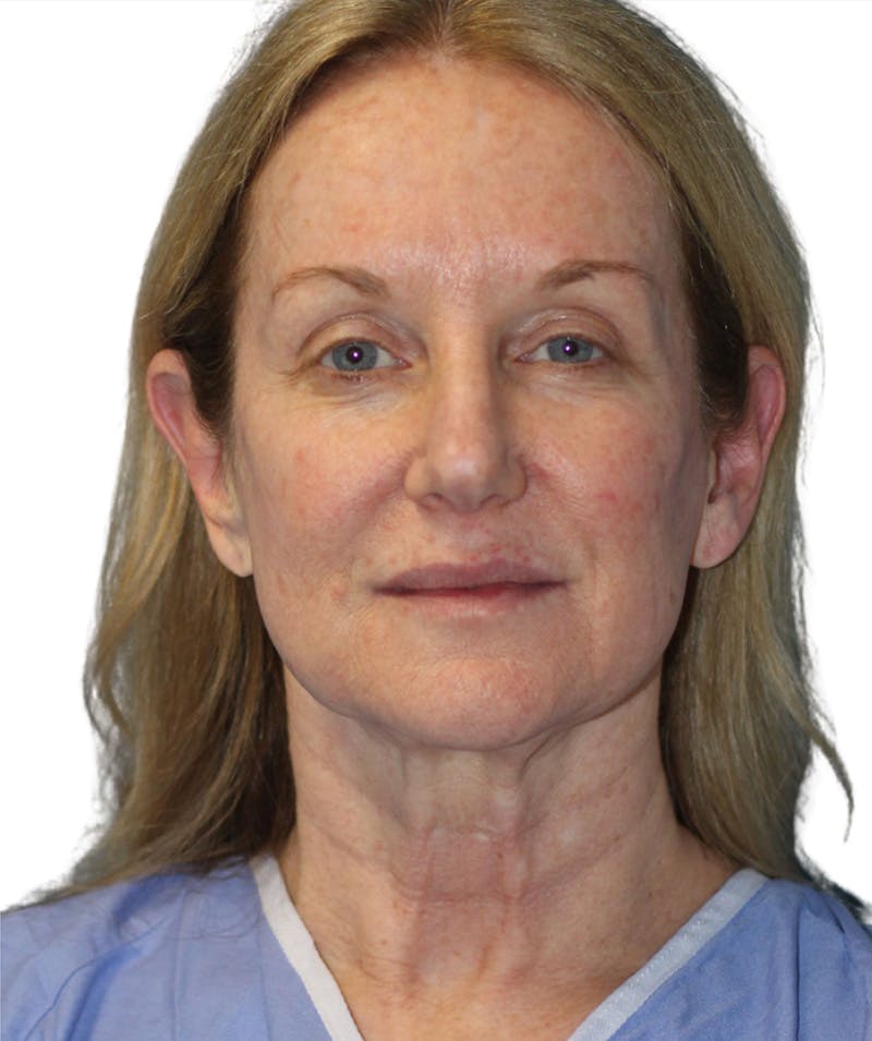 Facelift Before & After Gallery - Patient 399811 - Image 3