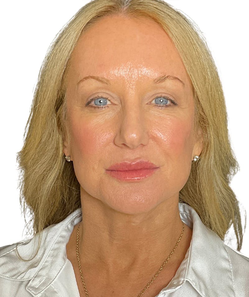 Facelift Before & After Gallery - Patient 399811 - Image 4