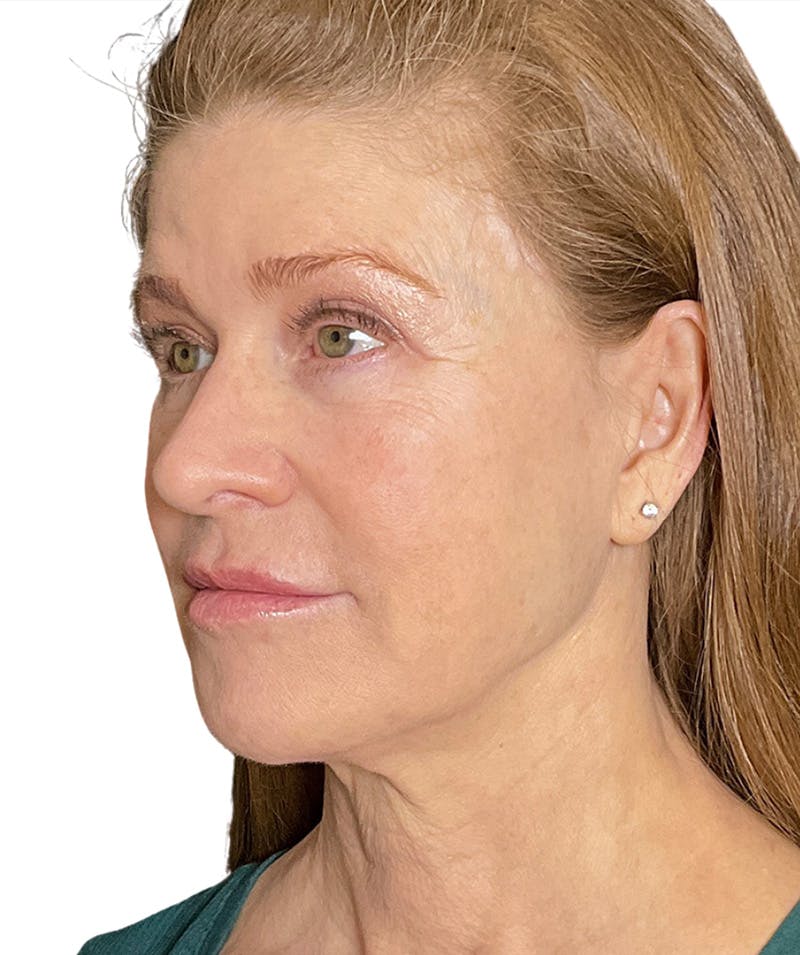 Facelift Before & After Gallery - Patient 213597 - Image 1