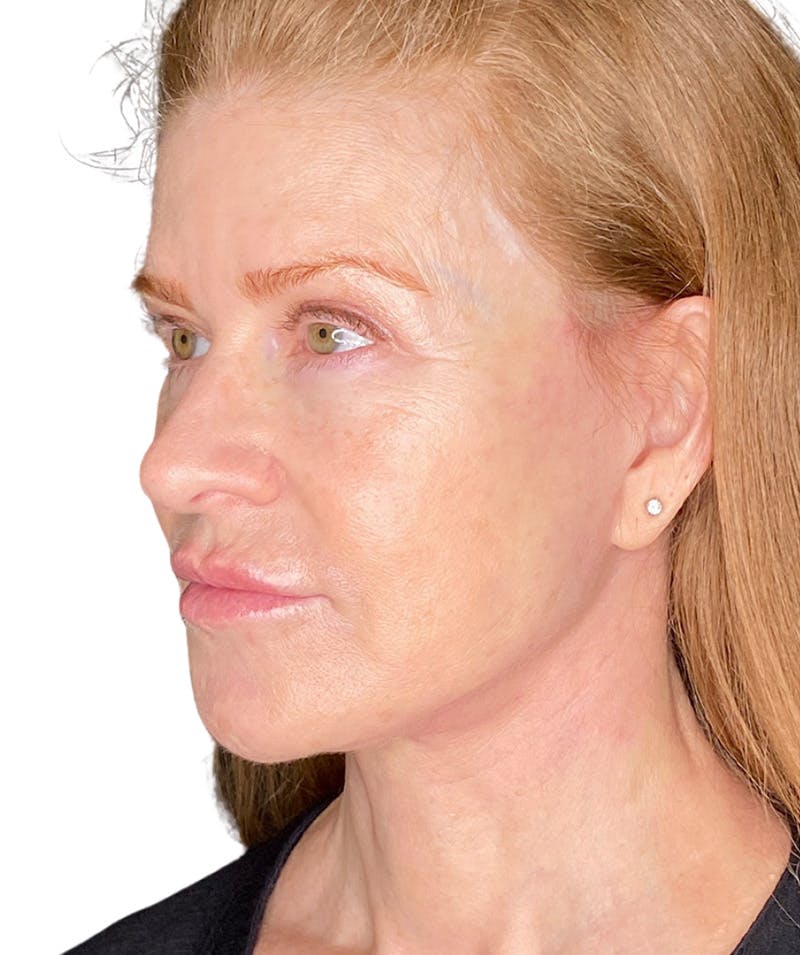 Facelift Before & After Gallery - Patient 213597 - Image 2