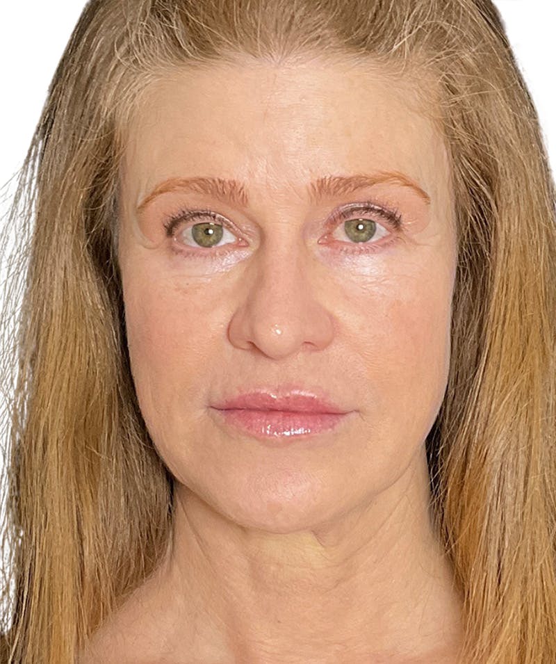 Facelift Before & After Gallery - Patient 213597 - Image 3