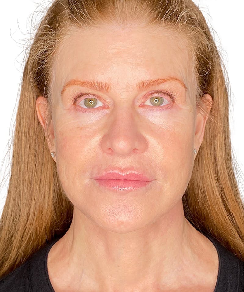 Facelift Before & After Gallery - Patient 213597 - Image 4