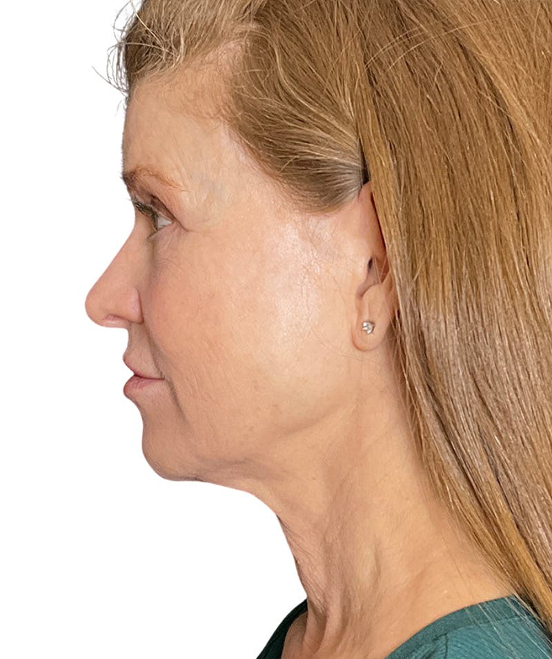 Facelift Before & After Gallery - Patient 213597 - Image 5