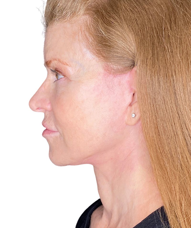 Facelift Before & After Gallery - Patient 213597 - Image 6