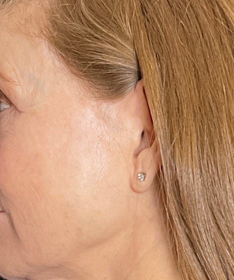 Facelift Before & After Gallery - Patient 213597 - Image 7