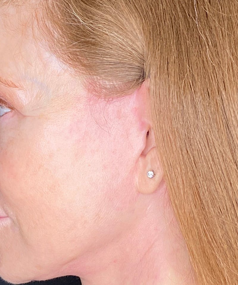 Facelift Before & After Gallery - Patient 213597 - Image 8