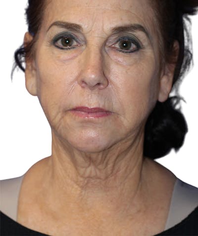 Facelift Before & After Gallery - Patient 213740 - Image 1