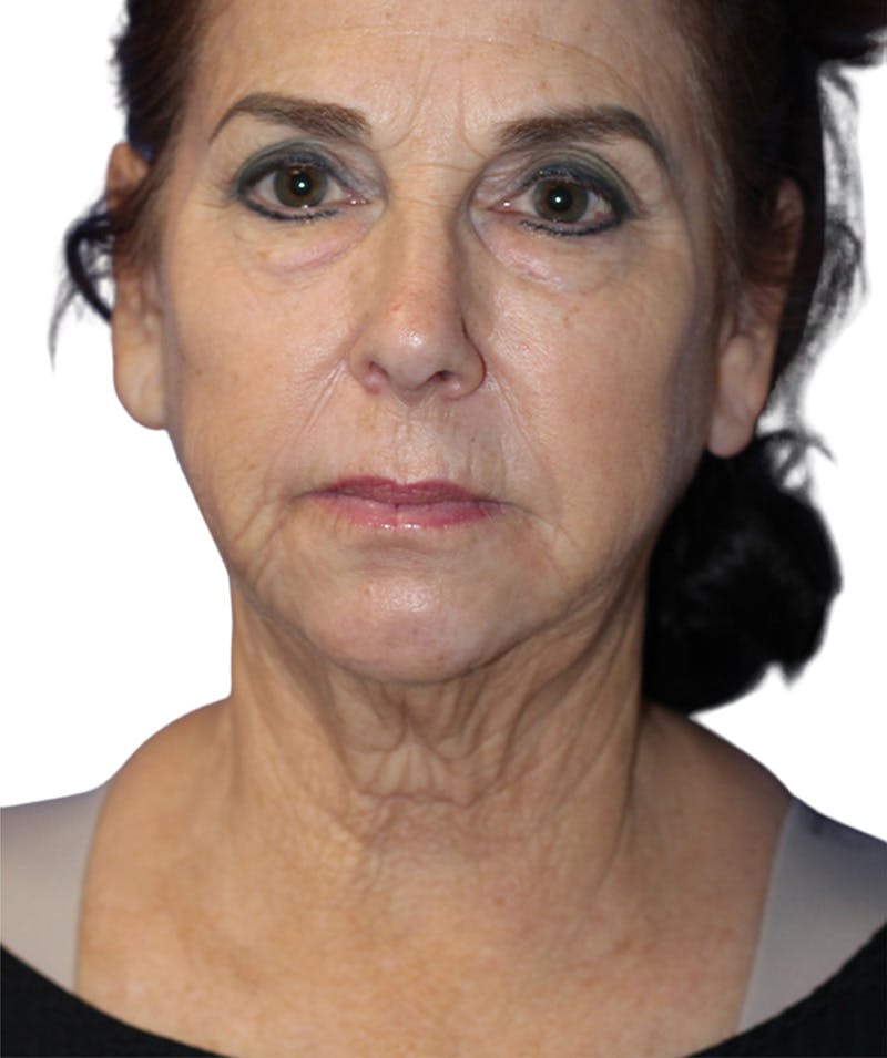 Facelift Before & After Gallery - Patient 213740 - Image 1