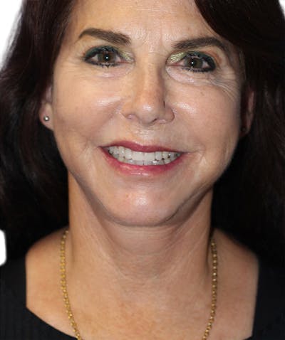 Facelift Before & After Gallery - Patient 213740 - Image 2