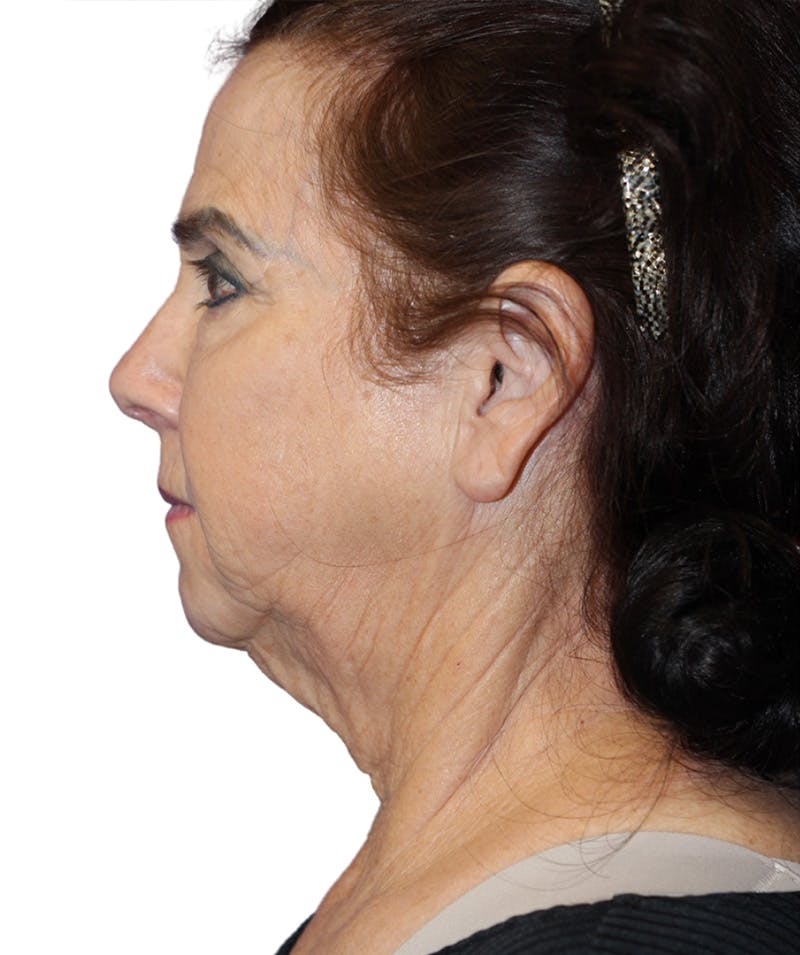 Facelift Before & After Gallery - Patient 213740 - Image 3