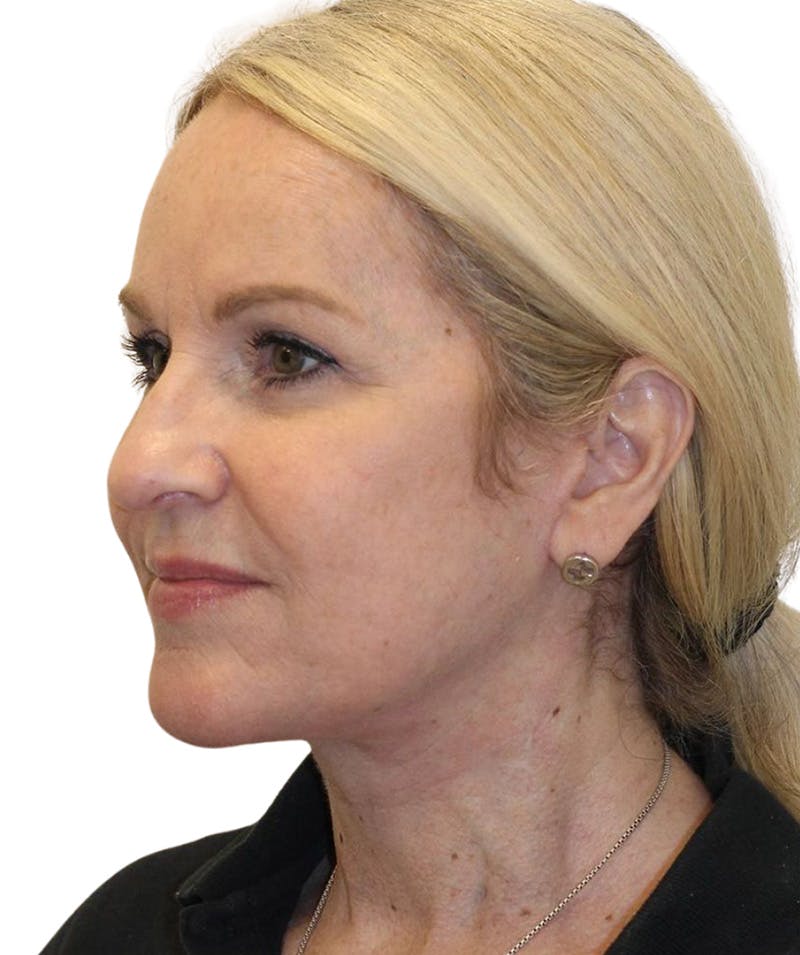 Facelift Before & After Gallery - Patient 418142 - Image 2